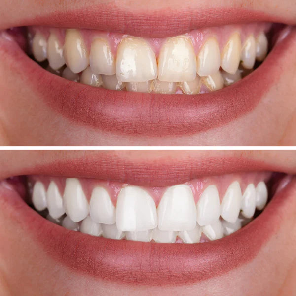 Blanqueamiento profesional — sin ir al dentista