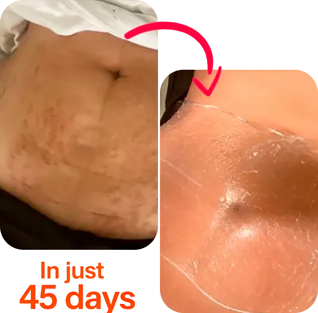 Resultados reales de CANDELA - Antes y después en 45 días