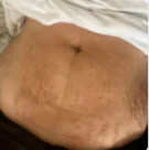 Celulitis - Antes