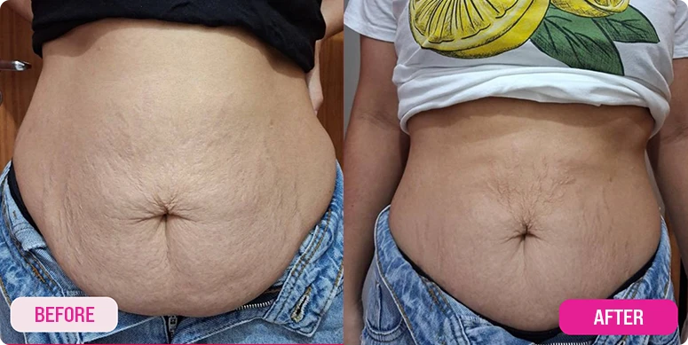 3. Melts Stubborn Fat While Firming Loose Skin