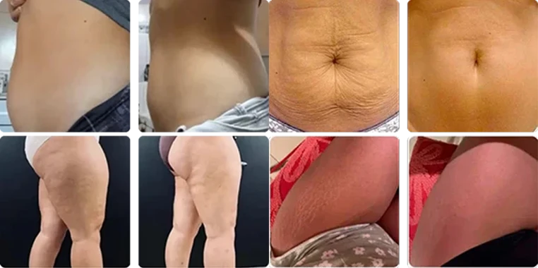 5. Targets the 'Stubborn Zones' Where Diet and Exercise Don't Work — Love Handles, Lower Belly, Inner Thighs